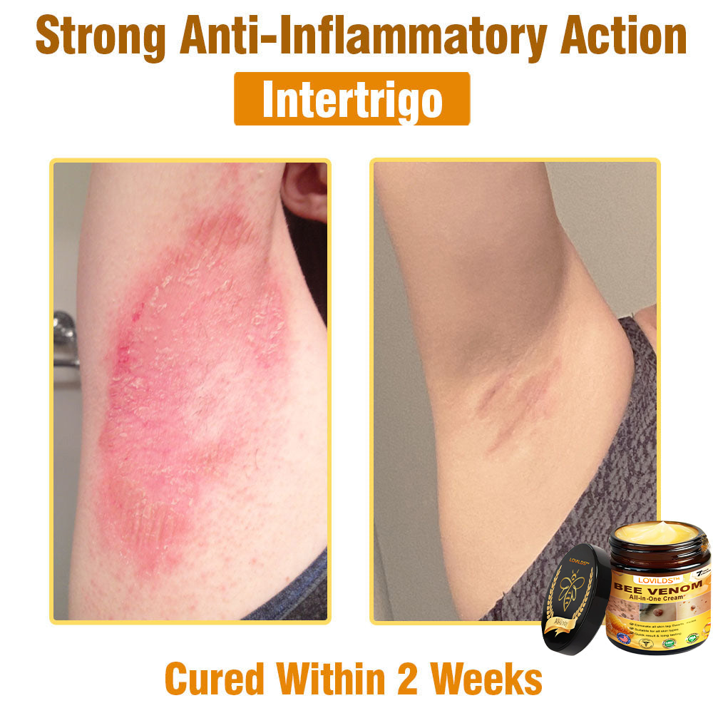 𝐋𝐎𝐕𝐈𝐋𝐃𝐒™ 𝐁𝐞𝐞 𝐕𝐞𝐧𝐨𝐦 𝐀𝐥𝐥-𝐢𝐧-𝐎𝐧𝐞 𝐂𝐫𝐞𝐚𝐦–🌸 Anti-aging,Hydrating, Skin Repair, Even Tone, Acne and Dark Spot Treatment, Wart and Mole Removal, Psoriasis Relief